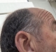Phonak Audeo Infinio Sphere 90 in graphite grey on right ear