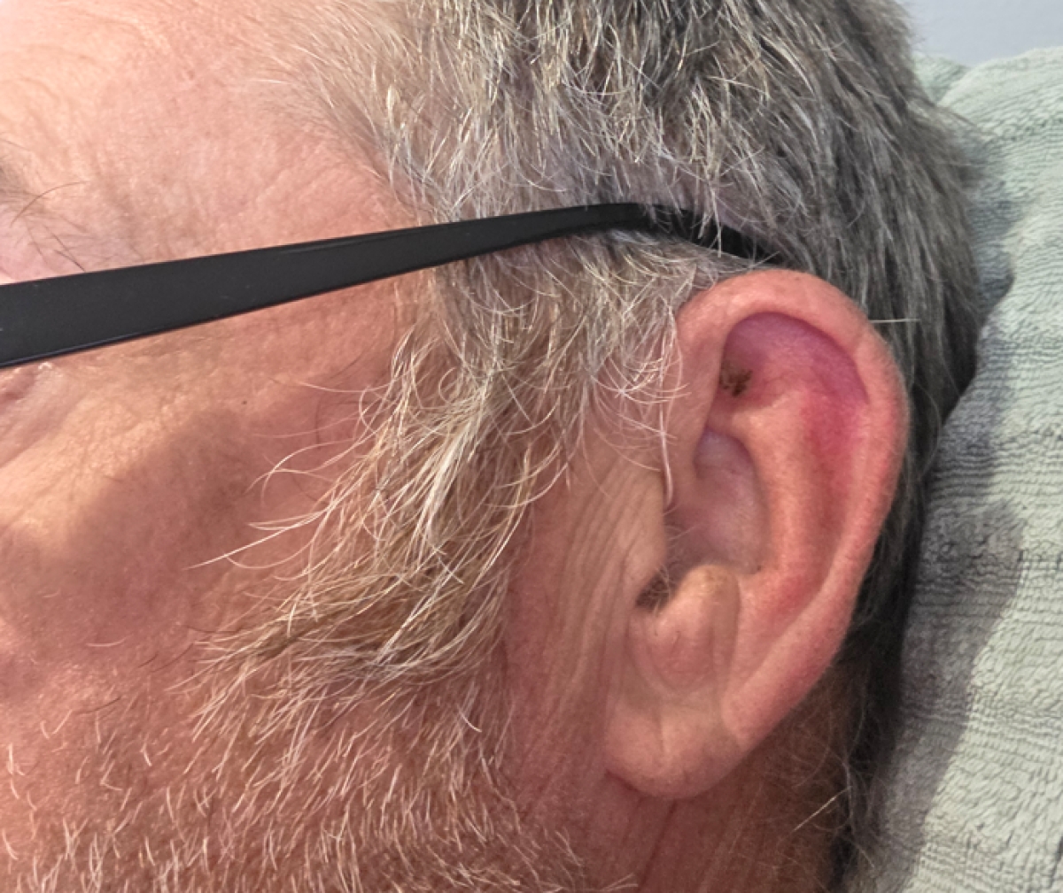 Oticon Reveal 2 in chroma beige in left ear closeup image